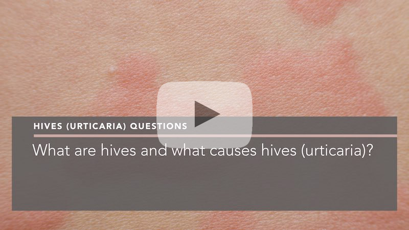 What Are Hives And What Causes Hives Penelope Pratsou Reading Dermatologist 1276